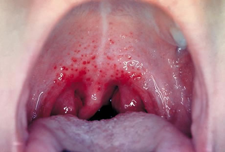 p125131 Điều trị bệnh viêm họng cấp tính