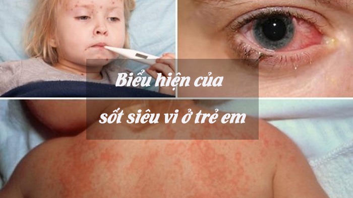 Nhận biết các dấu hiệu khi trẻ bị sốt siêu vi 1