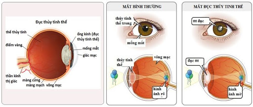 Bệnh đái tháo đường và những nguy cơ về mắt 1