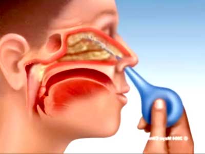 Hiểu cho đúng về rửa mũi điều trị viêm xoang 1