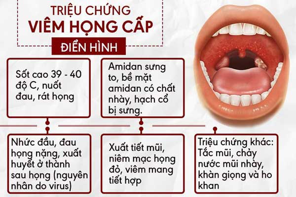 Triệu chứng của viêm mũi họng cấp 1