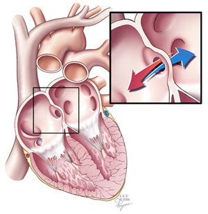 Tăng áp động mạch phổi là gì? 1