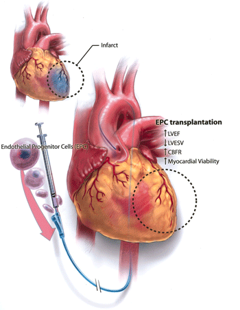 Biến chứng và lưu ý phòng ngừa nhồi máu cơ tim 1