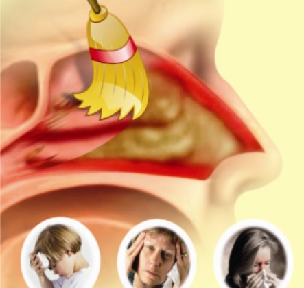 Viêm xoang mãn tính 1 Viêm xoang mãn tính 1