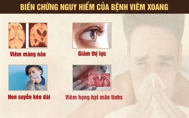 Viêm xoang mãn tính có biến chứng không? 1 Viêm xoang mãn tính có biến chứng không? 1