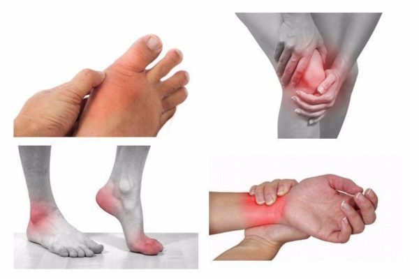 Nhức mỏi chân tay là bệnh gì? 1
