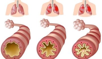Bệnh hen phế quản – Nguyên nhân, triệu chứng và cách phòng ngừa Bệnh hen phế quản – Nguyên nhân, triệu chứng và cách phòng ngừa
