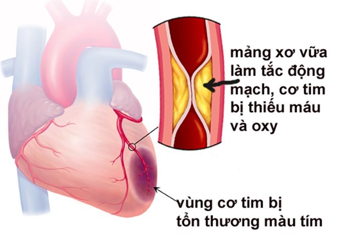 Vì sao rối loạn mỡ máu làm tăng nguy cơ tim mạch? 1