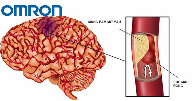 Nguyên nhân gây tai biến mạch máu não nhẹ 1