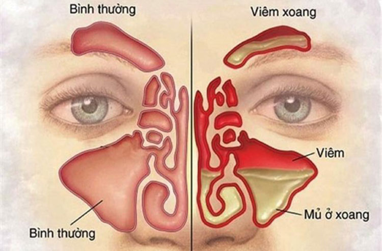 Những điều bạn cần biết về viêm đa xoang - Website chính thức của Omron tại  Việt Nam