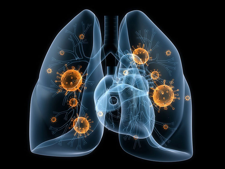 Viêm phổi là gì? 1