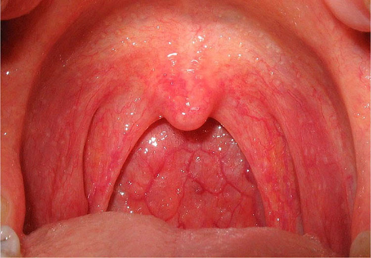 Tìm hiểu về bệnh viêm họng 1