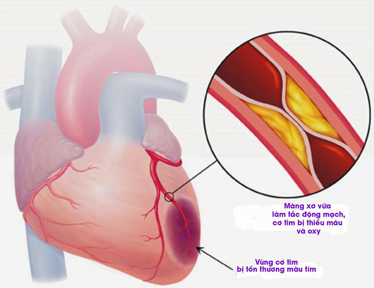 Nhồi máu cơ tim cấp là gì? 1