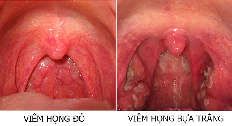 Viêm họng cấp: nguyên nhân, triệu chứng và cách điều trị tại nhà hiệu quả -  Website chính thức của Omron tại Việt Nam