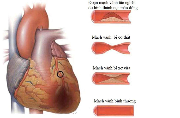 Nguyên nhân gây nhồi máu cơ tim cấp 1