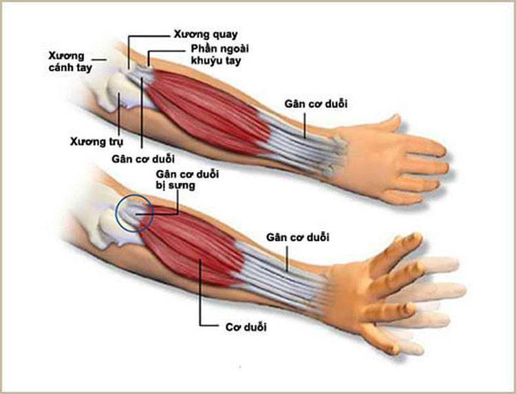 Nhức mỏi khớp khuỷu tay là bệnh gì? 1