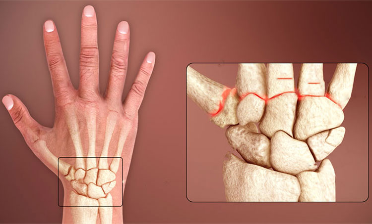 Nhức mỏi cổ tay phải là bệnh gì? 1