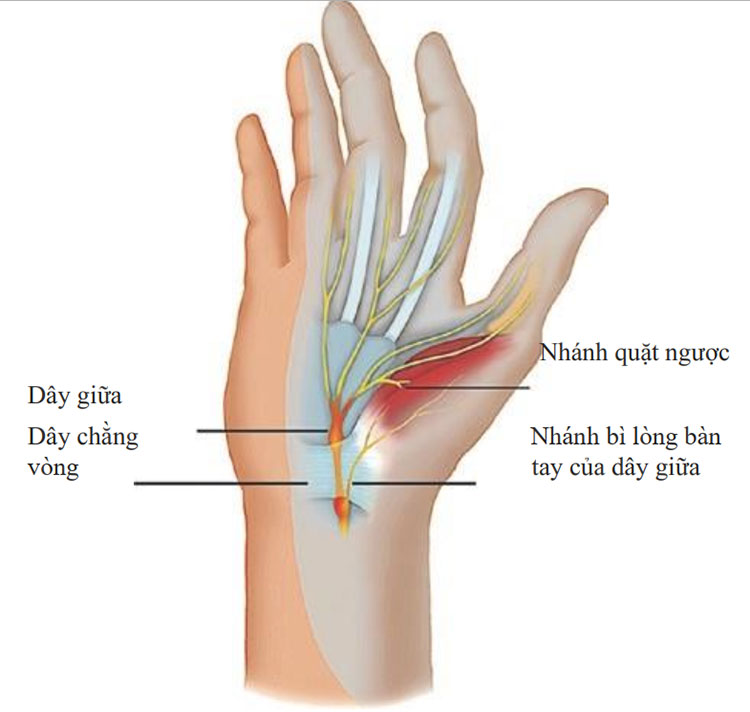 Hội chứng ống cổ tay 1